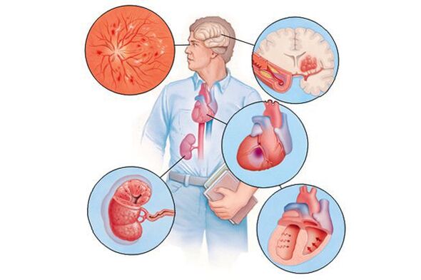 Schued op verschiddenen Organer mat verlängerter arterialer Hypertonie